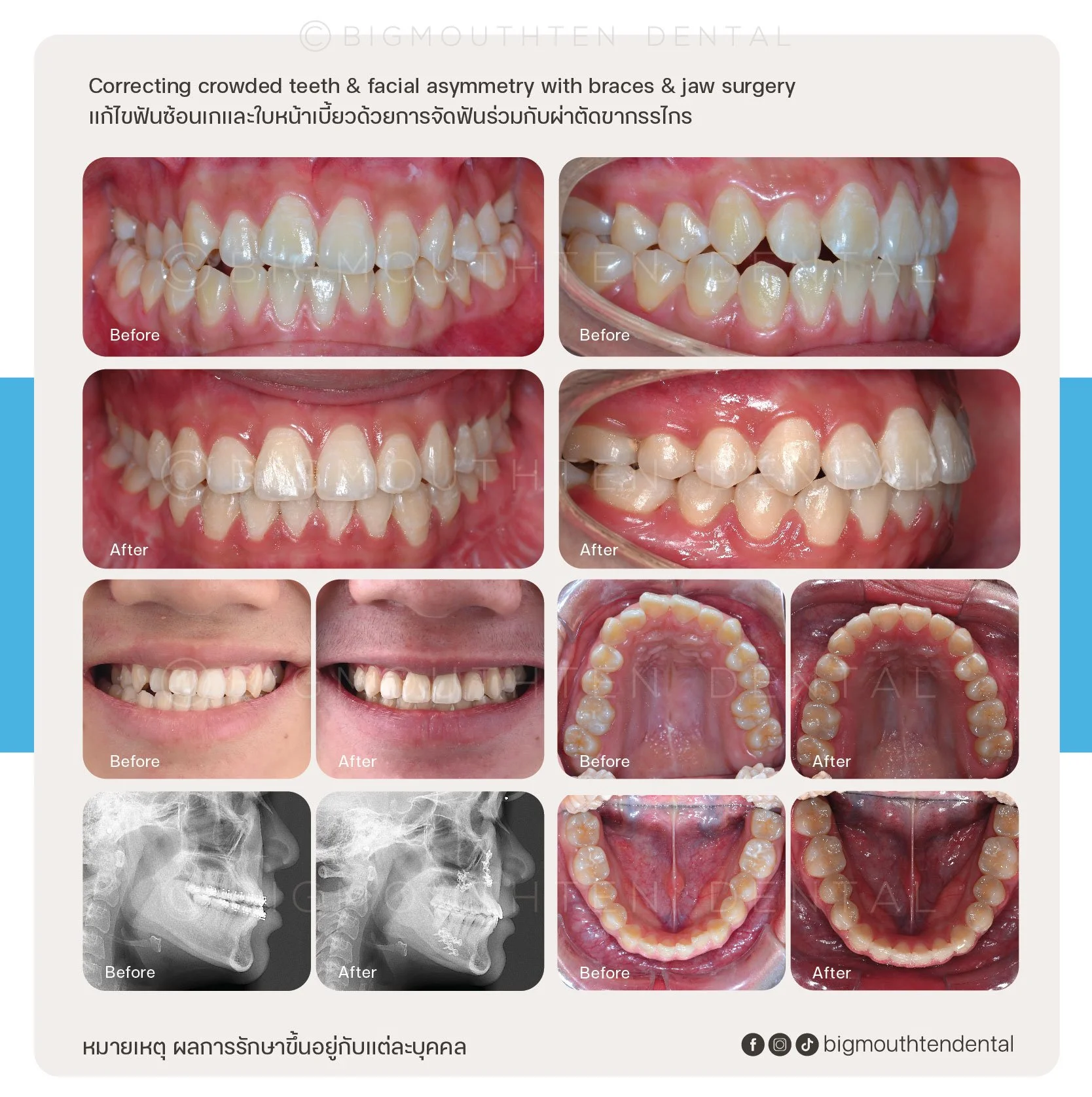 Dental before and after images showing corrected crowded teeth and facial asymmetry through braces and jaw surgery, including X-rays and intraoral views of the upper and lower arches.