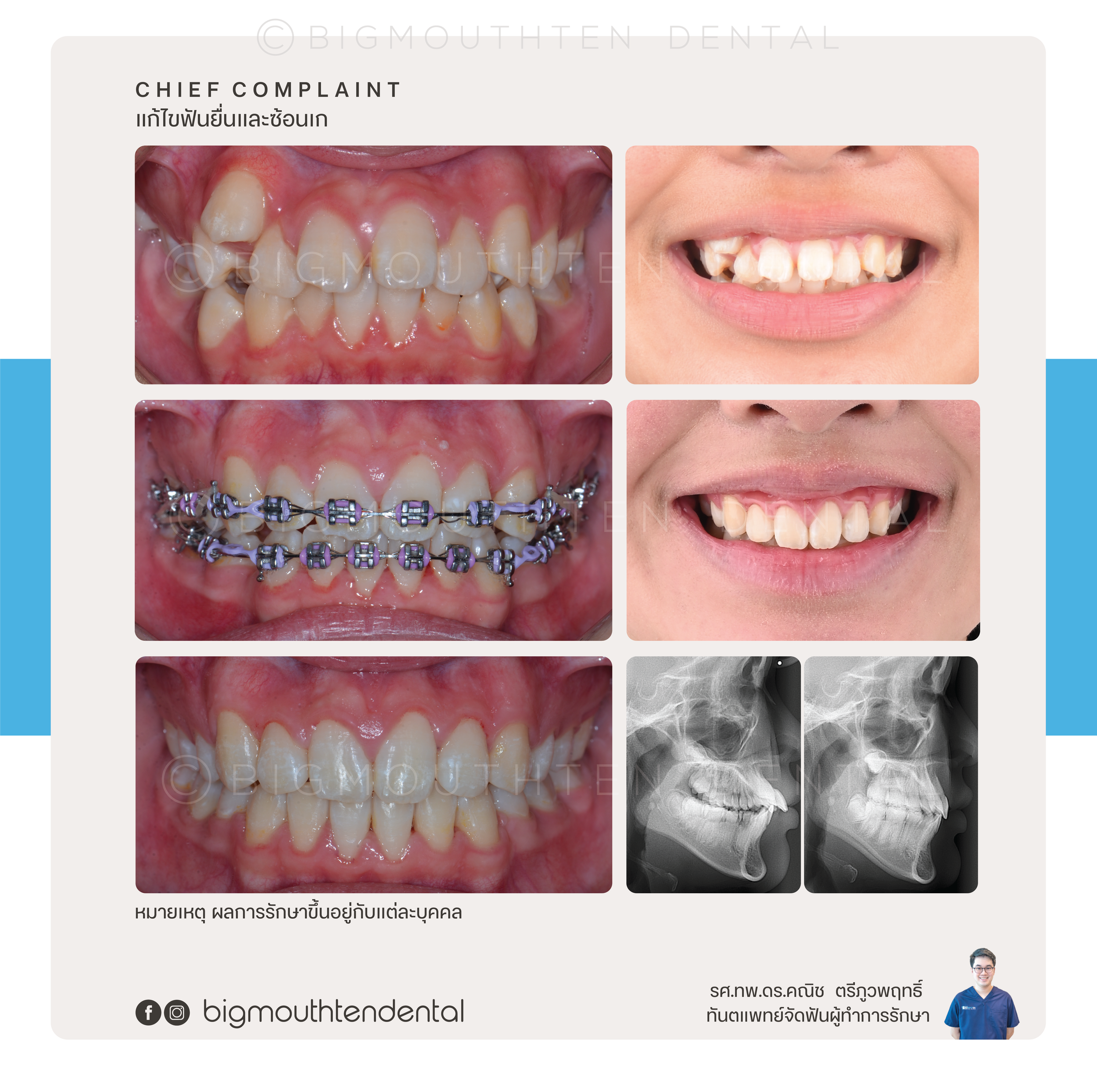 Before&After-orthodontic-braces-bigmouthten-chiangmai.png