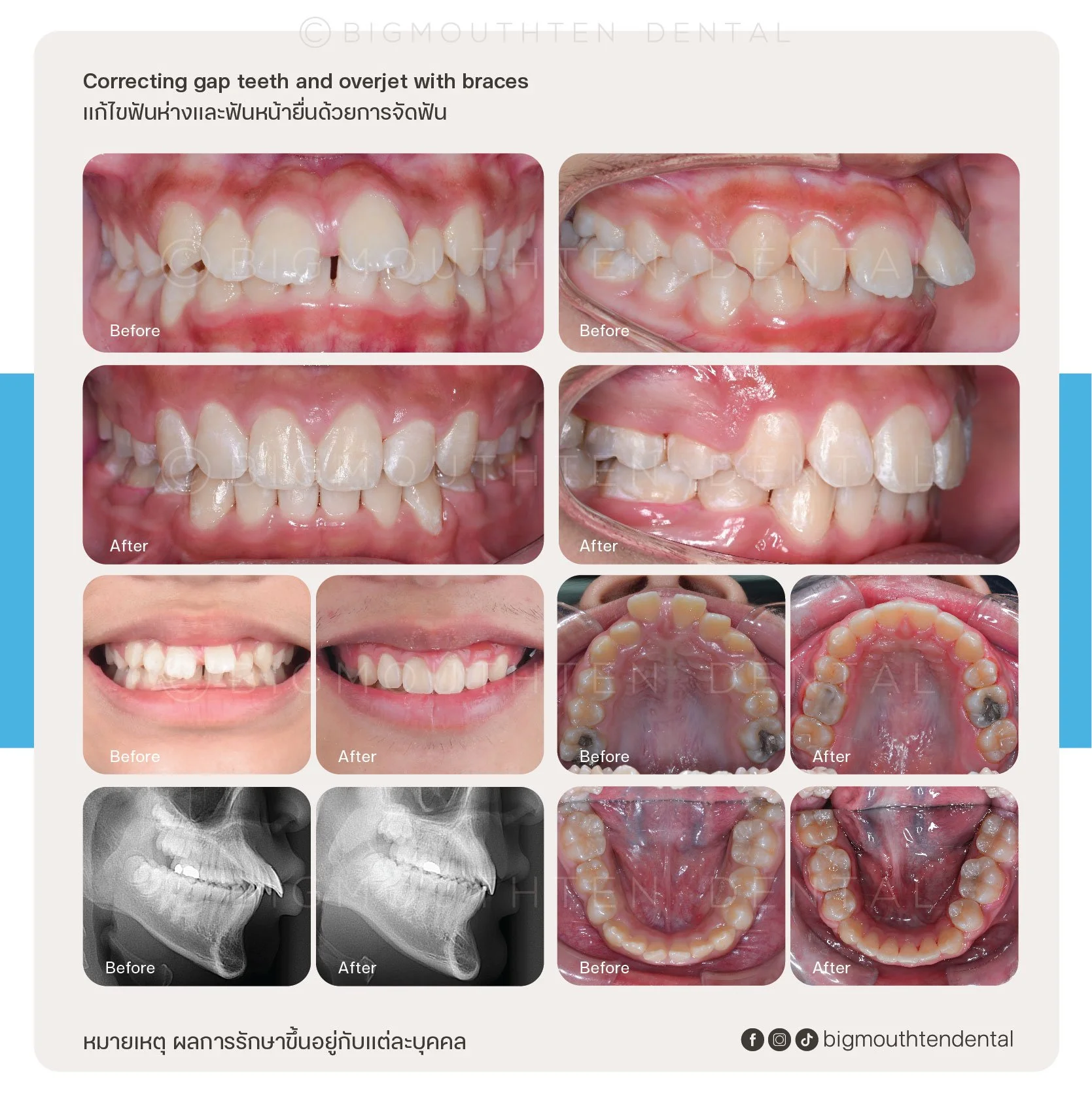 A dental treatment chart showing before and after images of correcting gap teeth and overjet using braces. The chart includes photos of teeth alignment, bite views, and X-rays, with text in English and Thai. The bottom contains social media icons and