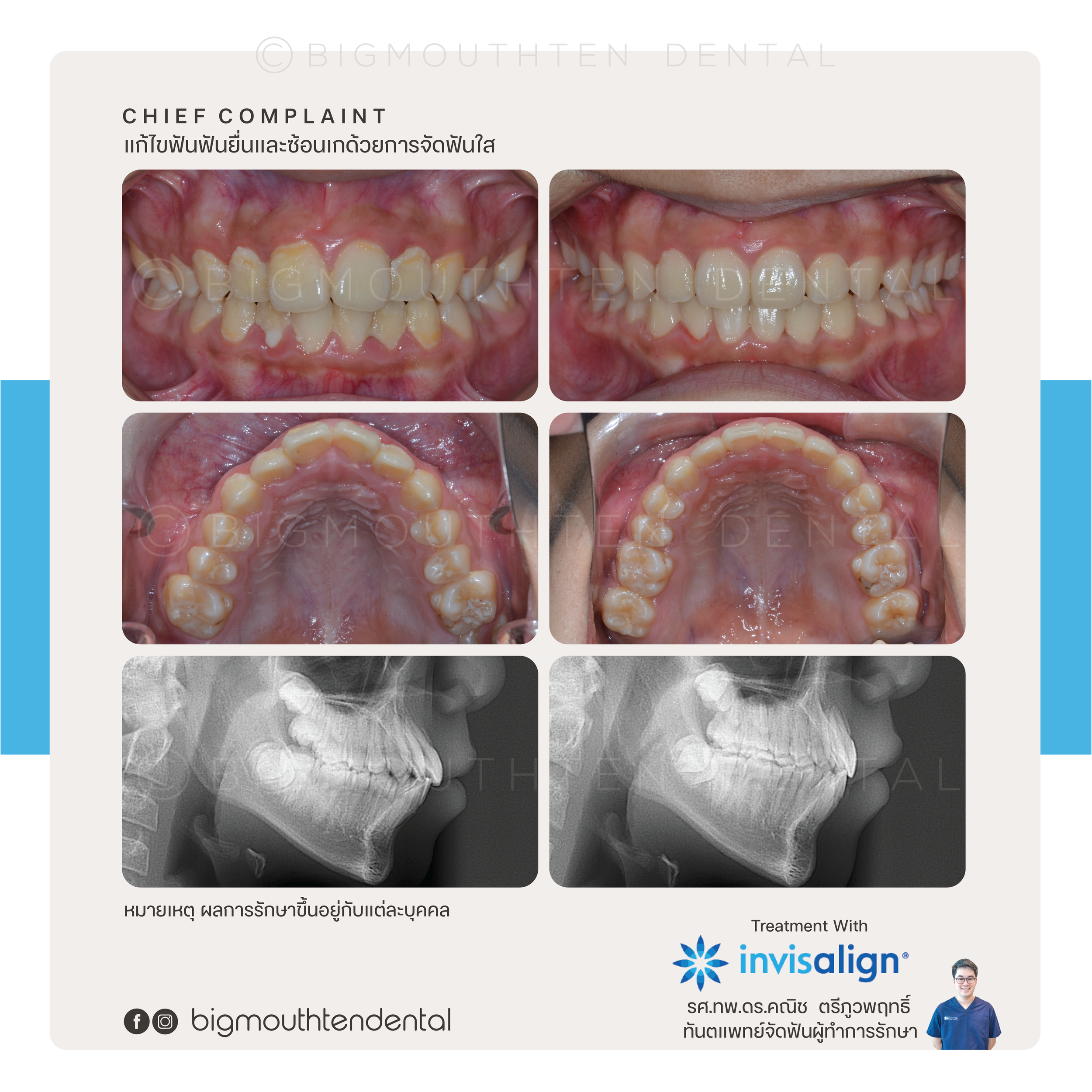 Before and after photos of a teeth correction treatment with Invisalign, showing improvements in dental alignment from multiple angles ก่อนหลังจัดฟันใส เคสรีวิว จัดฟันใส เชียงใหม่