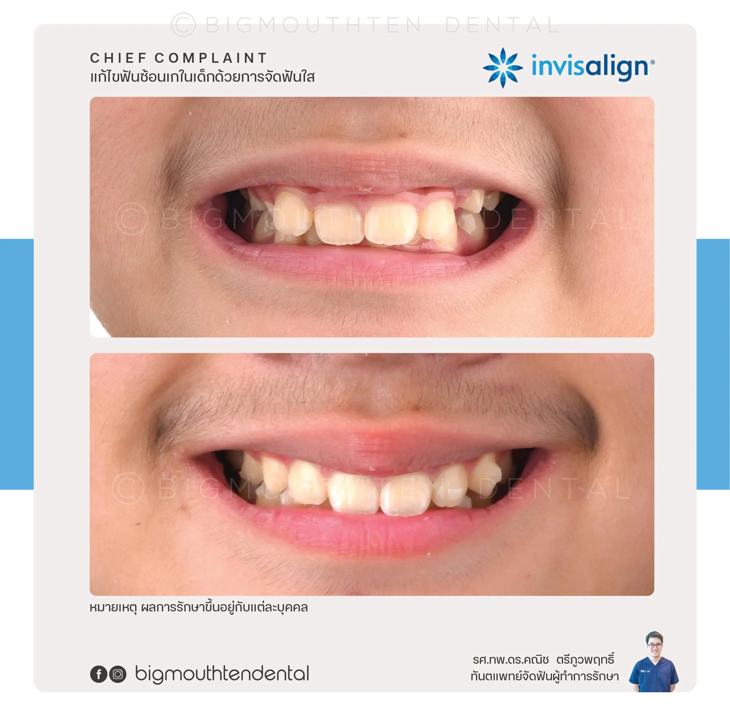 kid‑orthodontics‑chiangmai‑bigmouthten.jpg