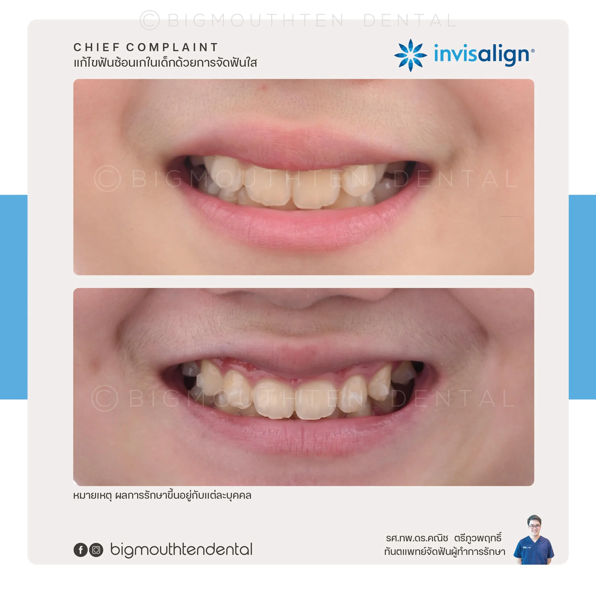 kid‑orthodontics‑chiangmai‑bigmouthten.jpg