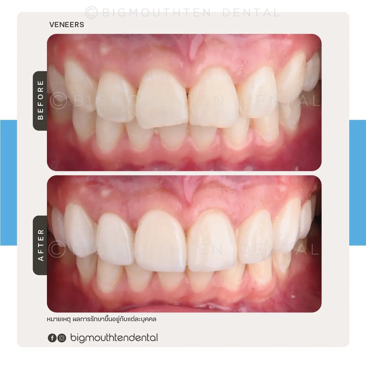 Comparison of teeth before and after dental veneer treatment showing improved appearance and alignment.