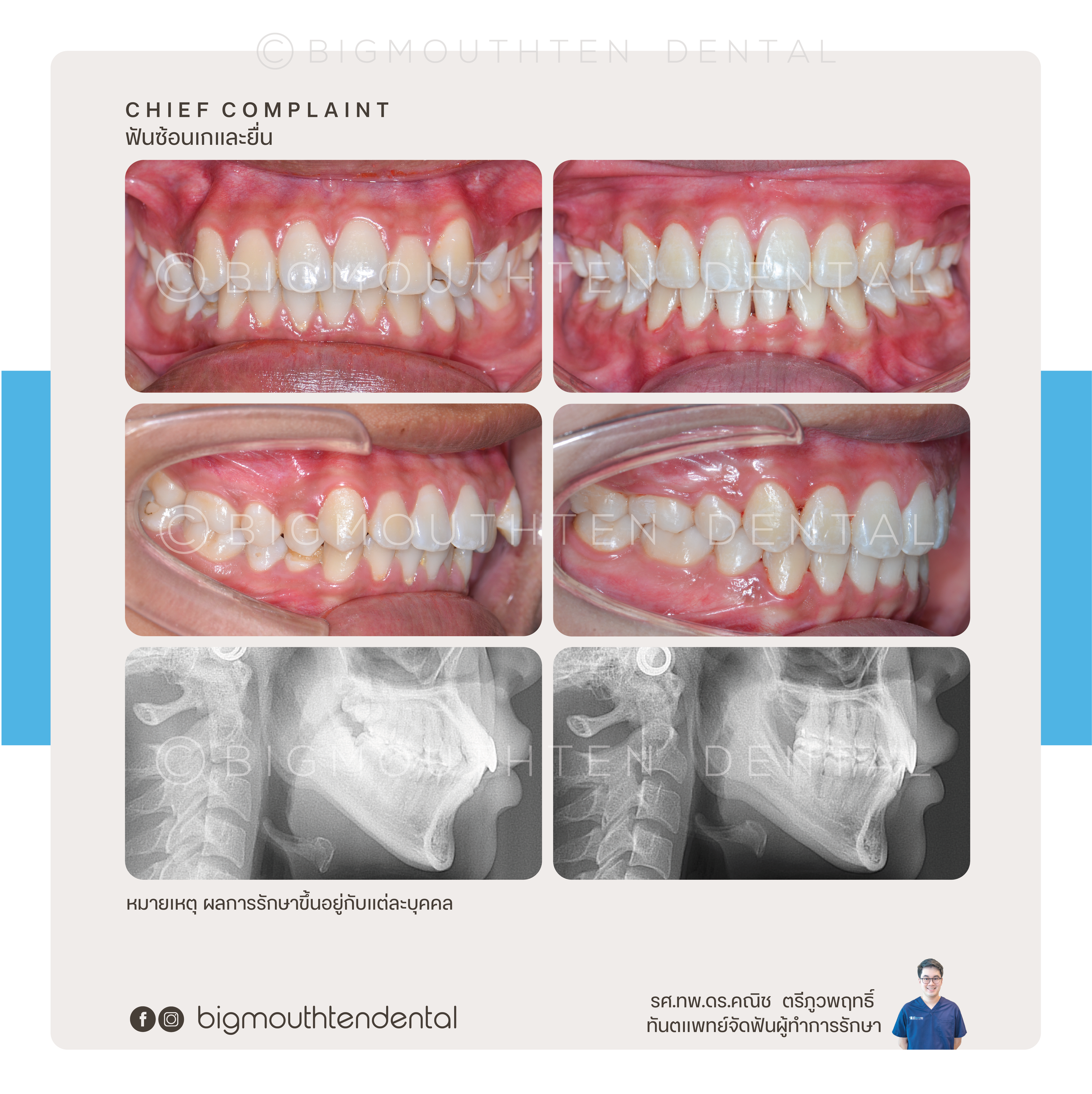 Before&After-orthodontic-braces-bigmouthten-chiangmai.png
