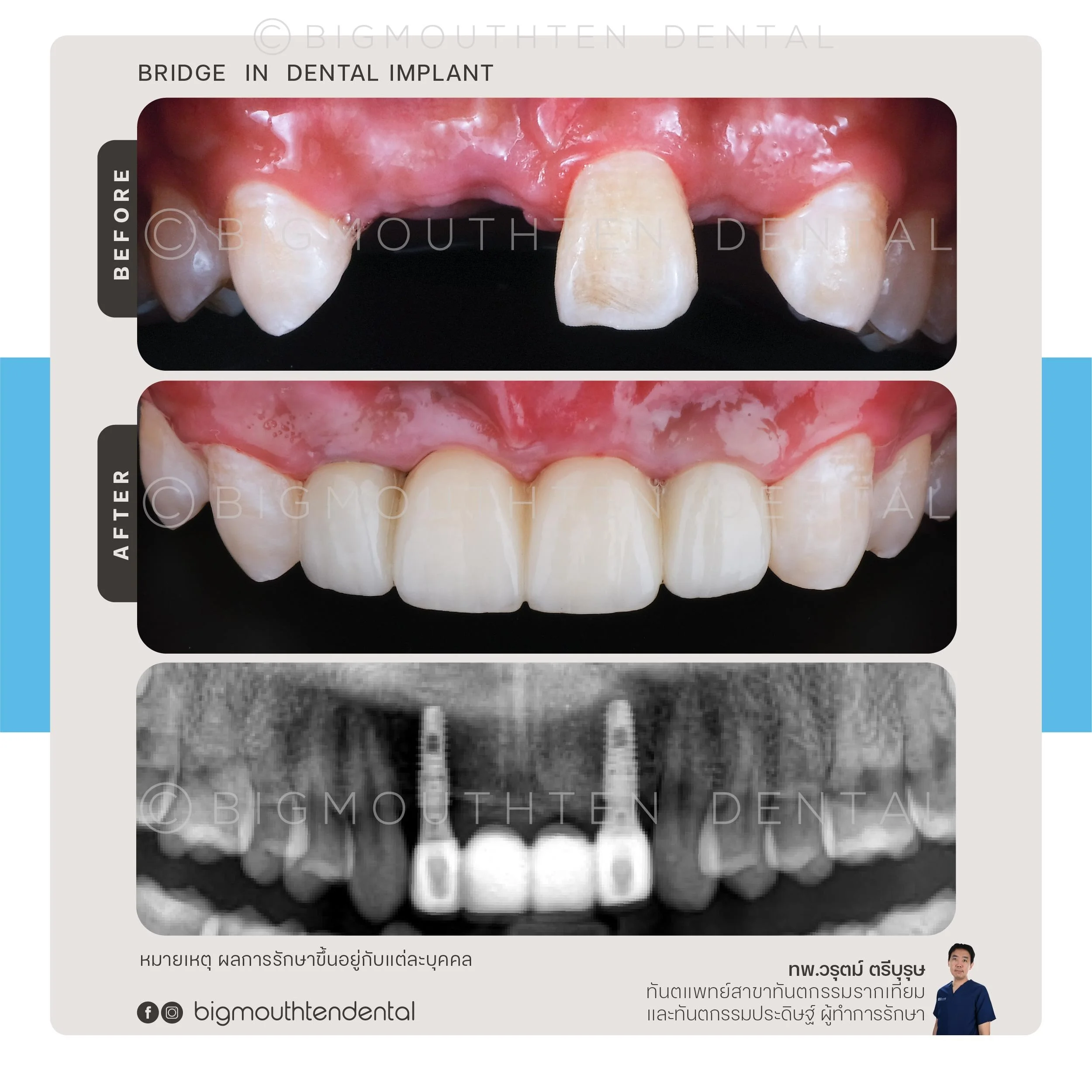 เคสฝังรากเทียมหลายซี่เพื่อฟื้นฟูการเคี้ยวและรอยยิ้ม
Full-arch dental implants for smile and function restoration