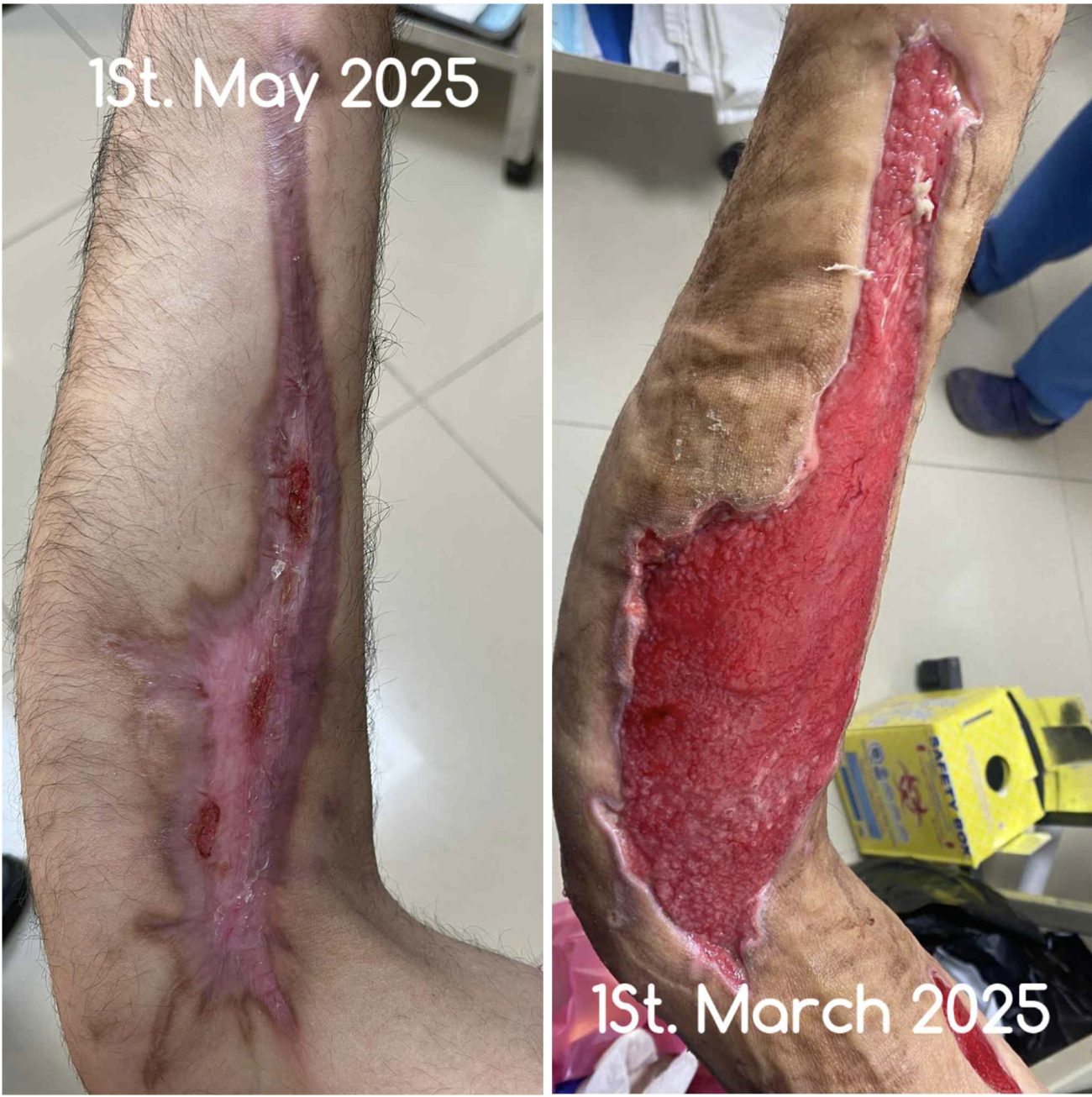 The Science of Red Light Therapy for Wound Healing and Scar Care