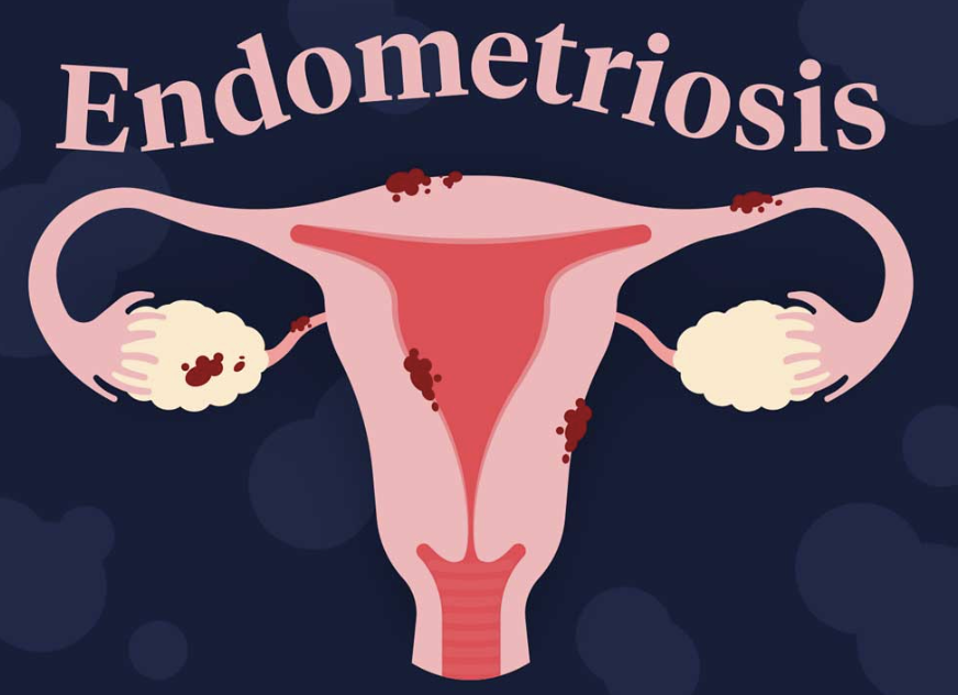 Red Light Therapy for Endometriosis - Instant Genetic Changes