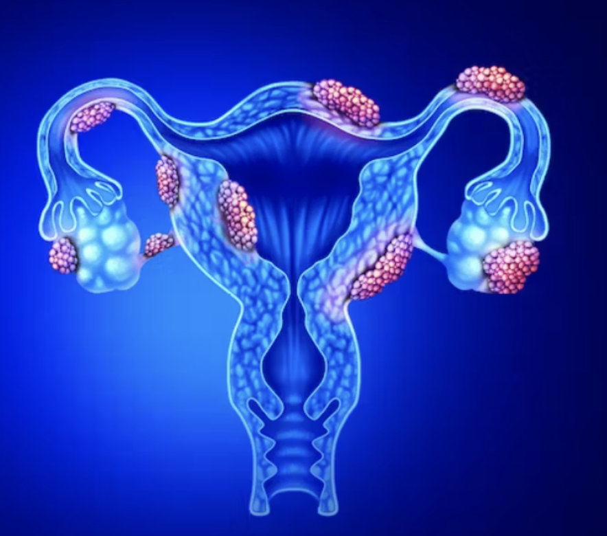 Red Light Therapy for Endometriosis: Does it work?