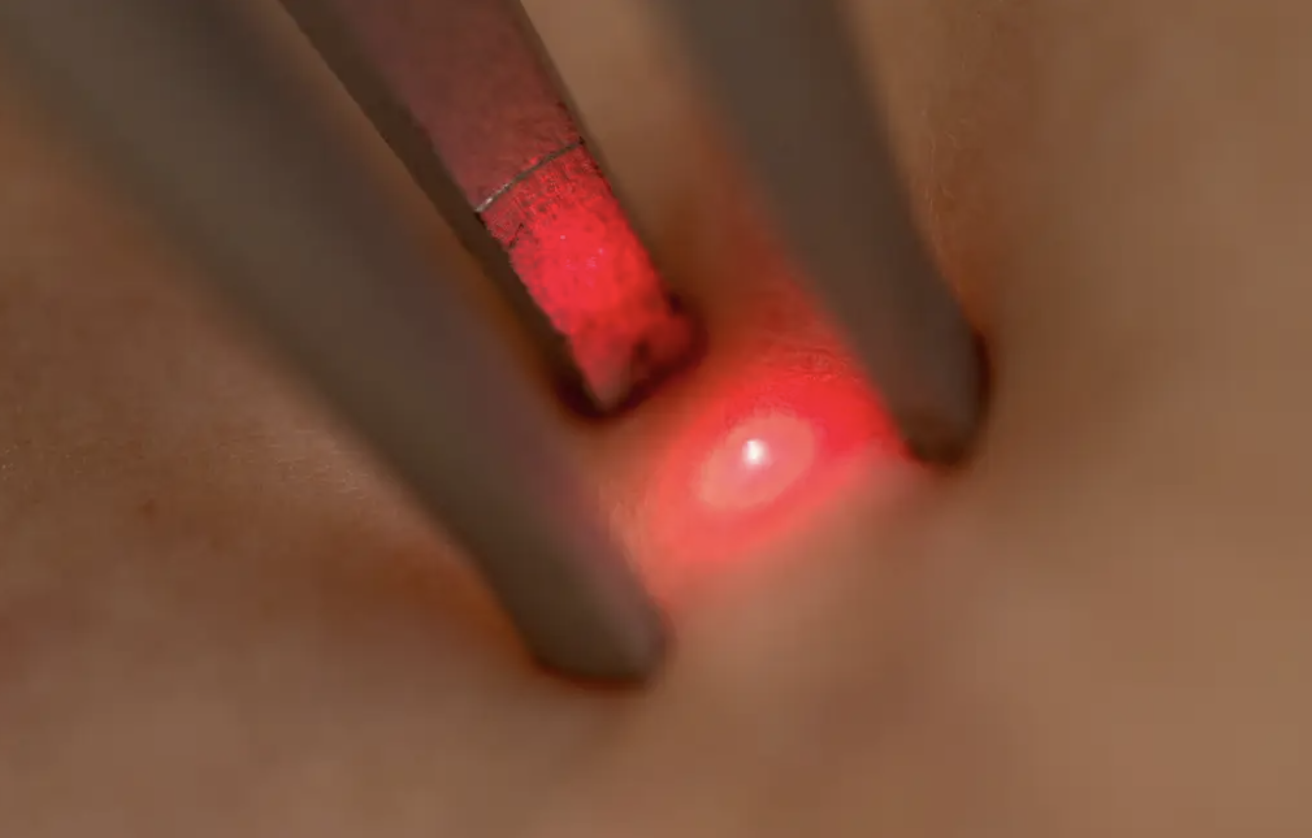 Laser Vs Steroid Cream for Lichen Sclerosus 
