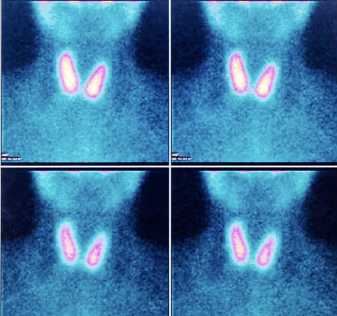 Trying to Conceive with Thyroid Antibodies? What the TABLET Trial Found.