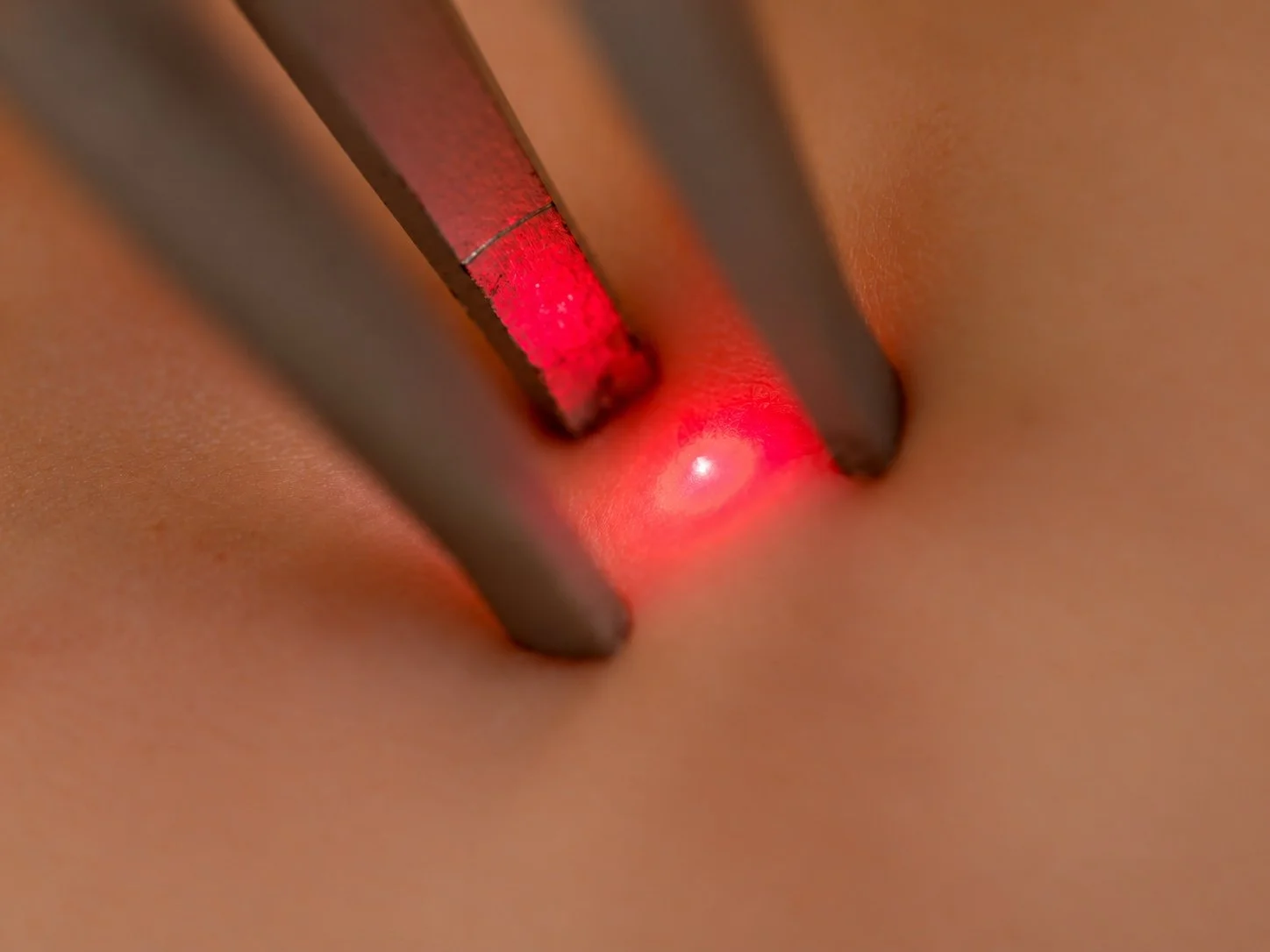 Laser Vs Steroid Cream for Lichen Sclerosus 