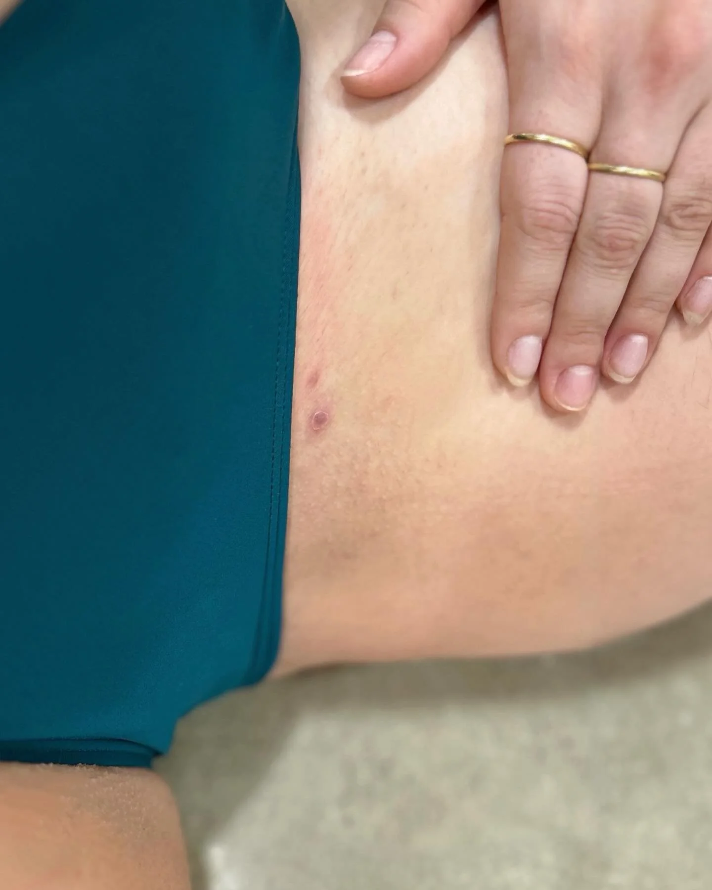 Pssst: for all the girlies who exfoliate, and treat, and moisturize, but still end up with one of these angry ingrowns - there is a solution! Any guesses? Drop &lsquo;em in the comments and we&rsquo;ll post the answer tomorrow!