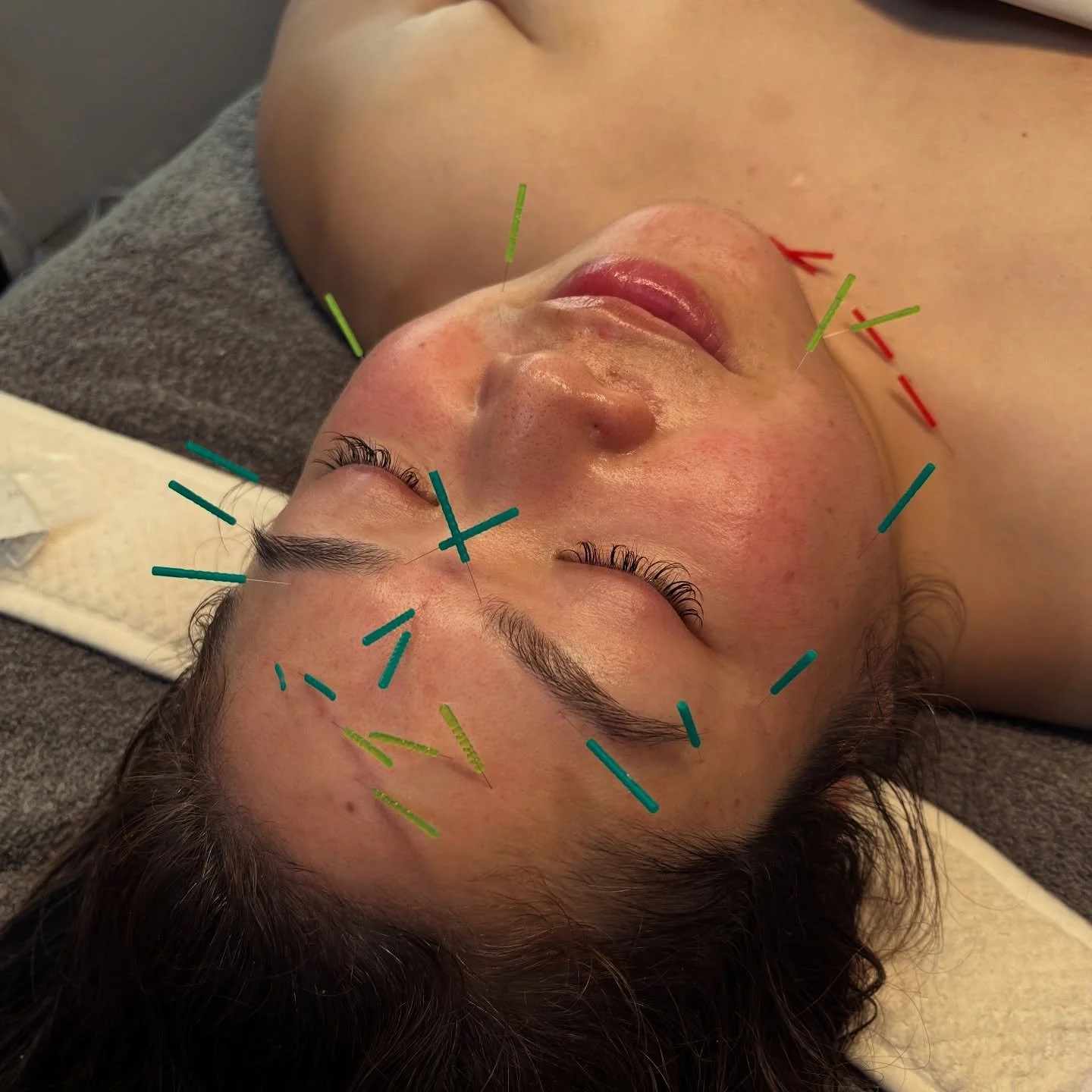 🎄✨ DELUXE FACIAL ACUPUNCTURE TREATMENT ✨🎄

My facial acupuncture sessions prioritize your relaxation. I spend a lot of time doing facial, neck/ d&eacute;colletage, shoulder, scalp, and lymphatic massage using my hands and guasha tools. The deluxe t
