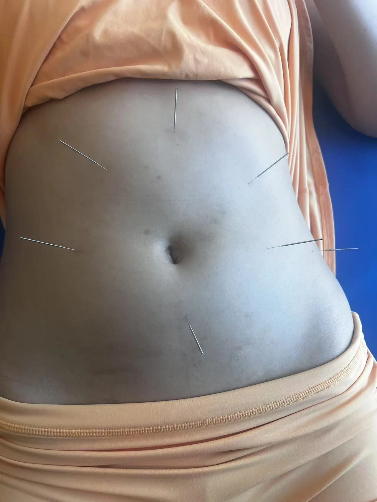 A human abdomen with several acupuncture needles inserted into the skin.