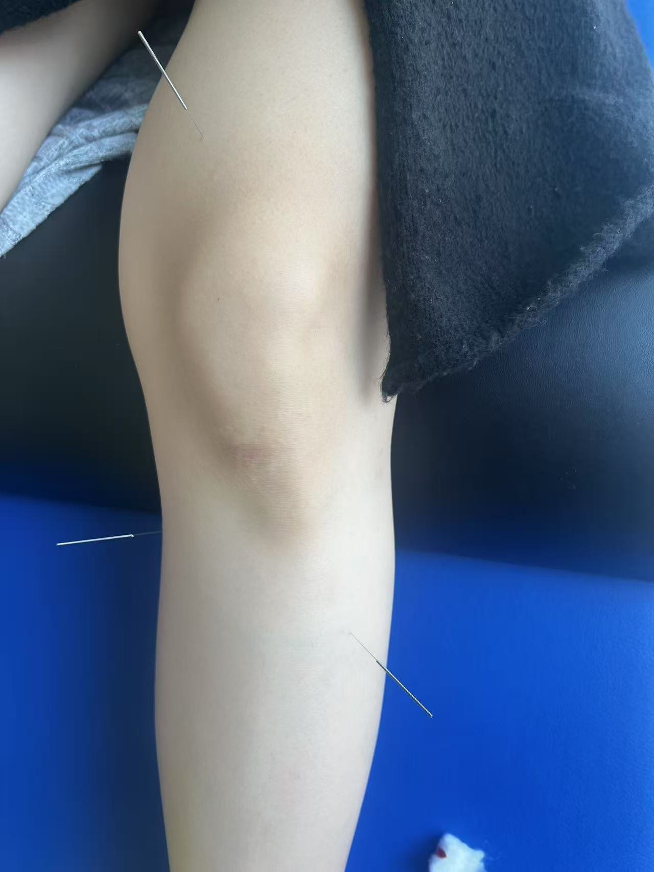 A person's leg with acupuncture needles inserted at the knee and thigh.