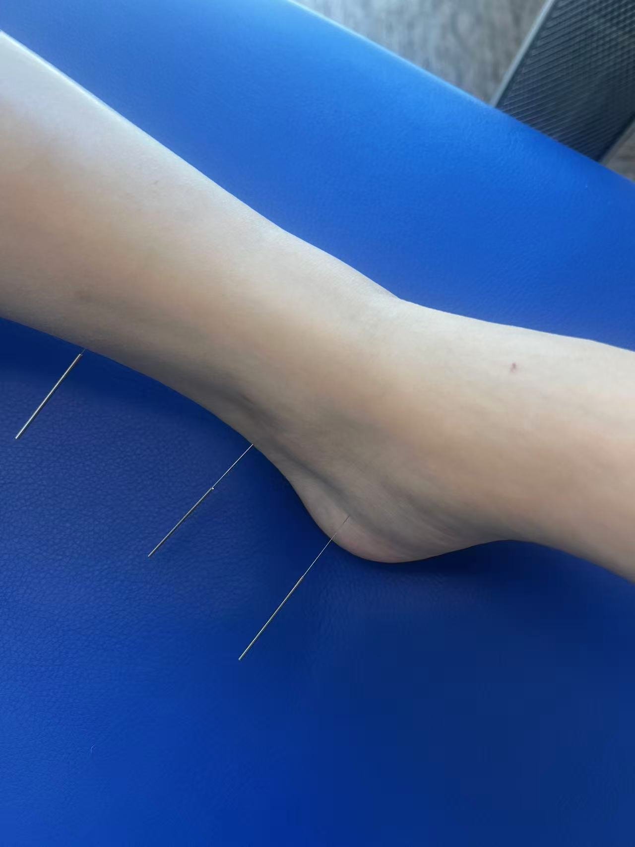 A person's forearm and hand with acupuncture needles inserted, resting on a blue surface.