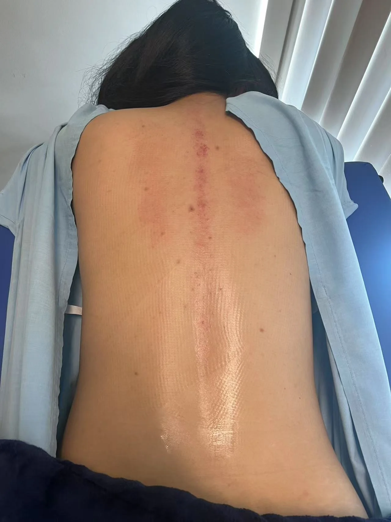 Back of a person with visible scar and redness along the spine, lying on an examination table.