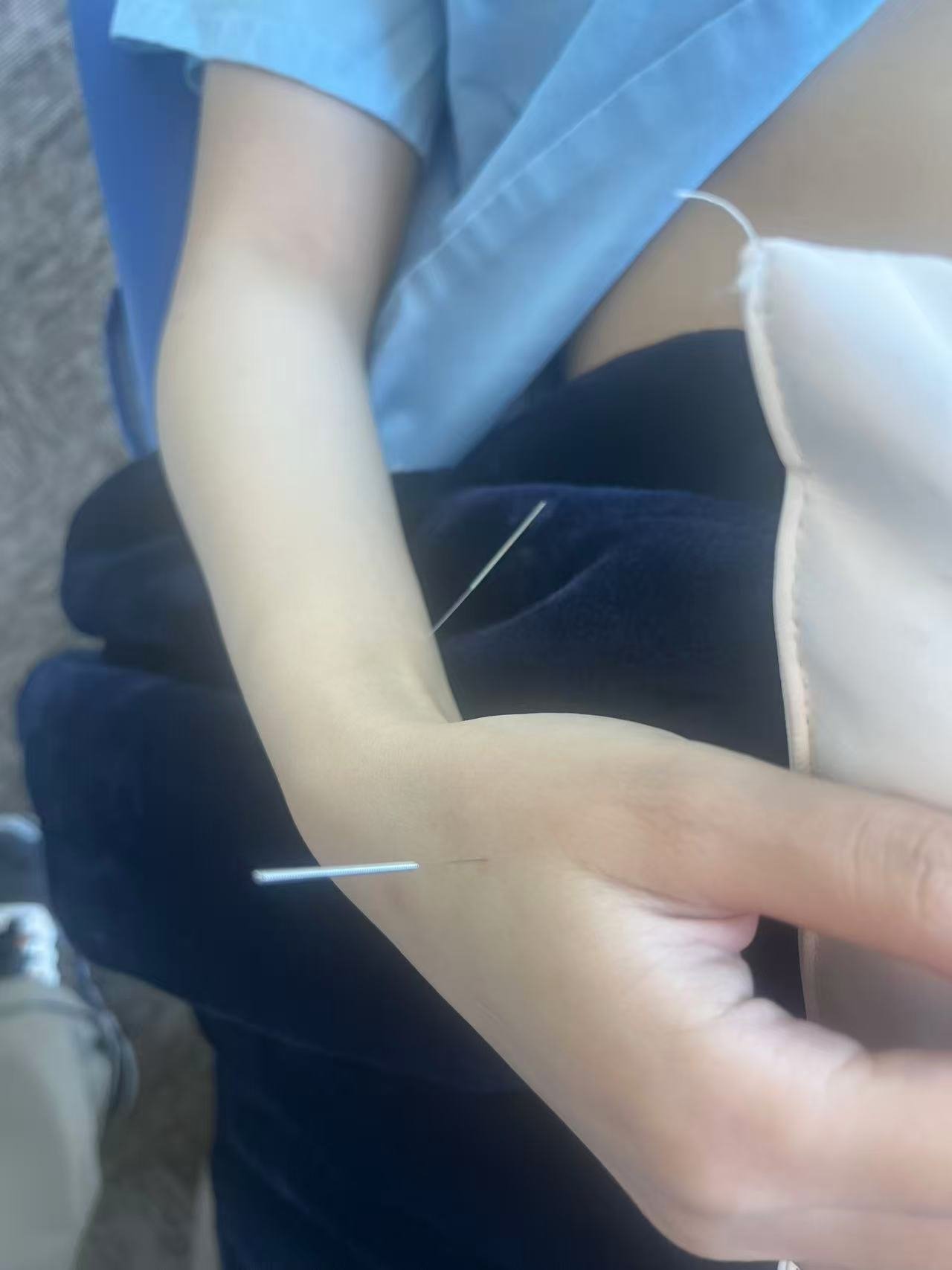 Close-up of a person's arm with acupuncture needles inserted, wearing a light-colored shirt and sitting outdoors.