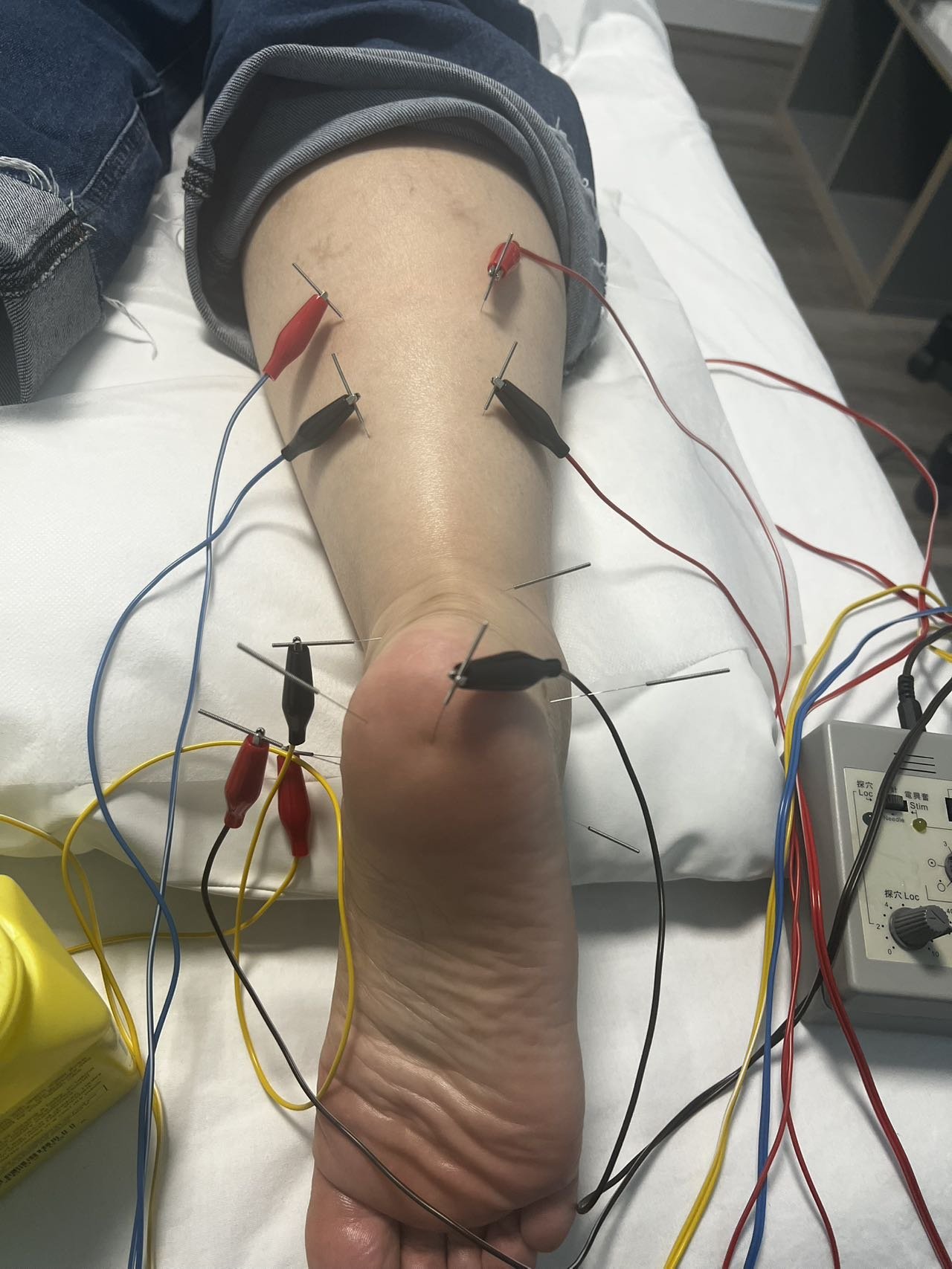 Plantar fasciitis -Acupuncture.jpeg