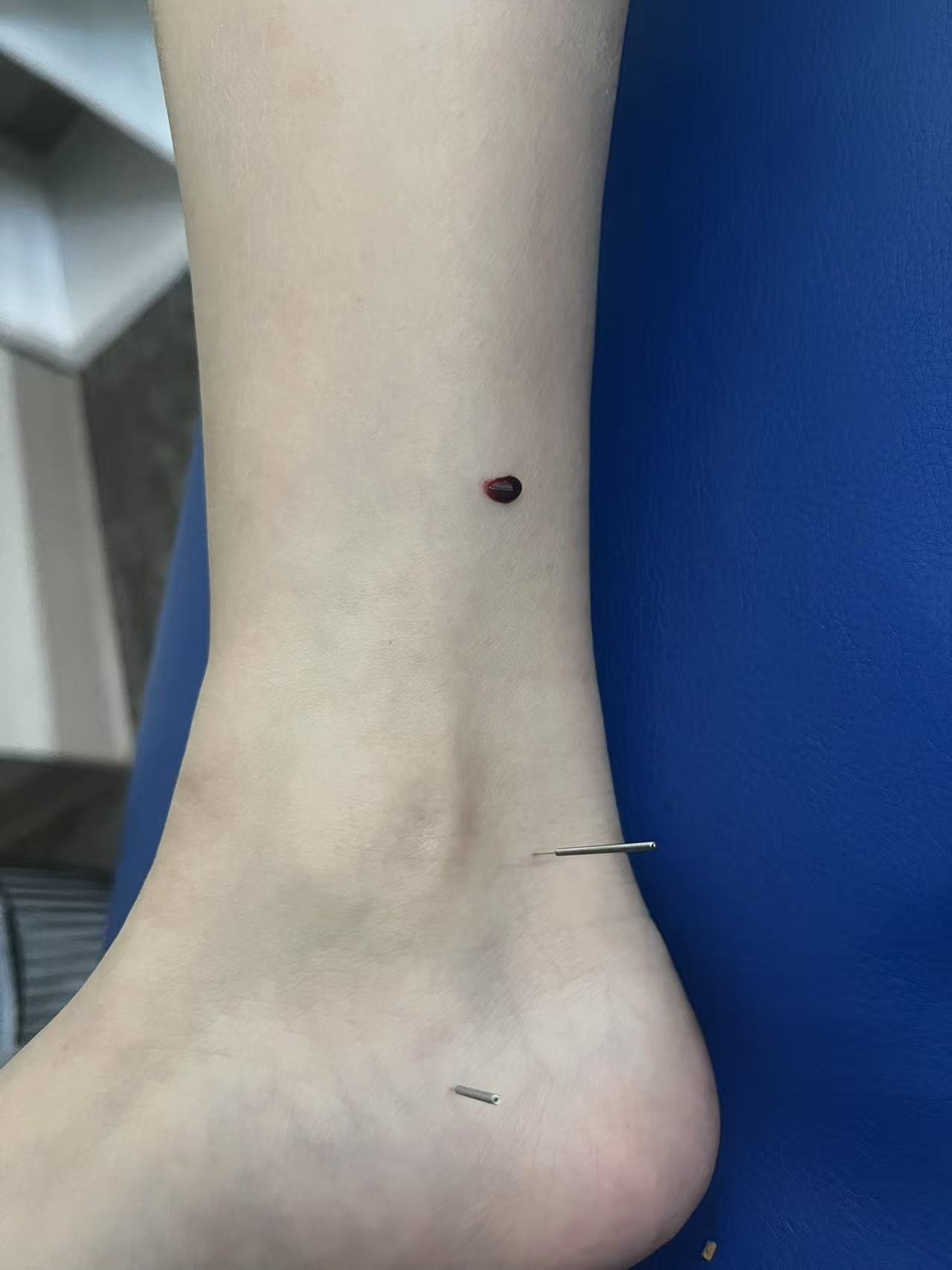 A medical procedure on a person's ankle with two pins inserted, one dot wound with blood, and a blue medical drape.
