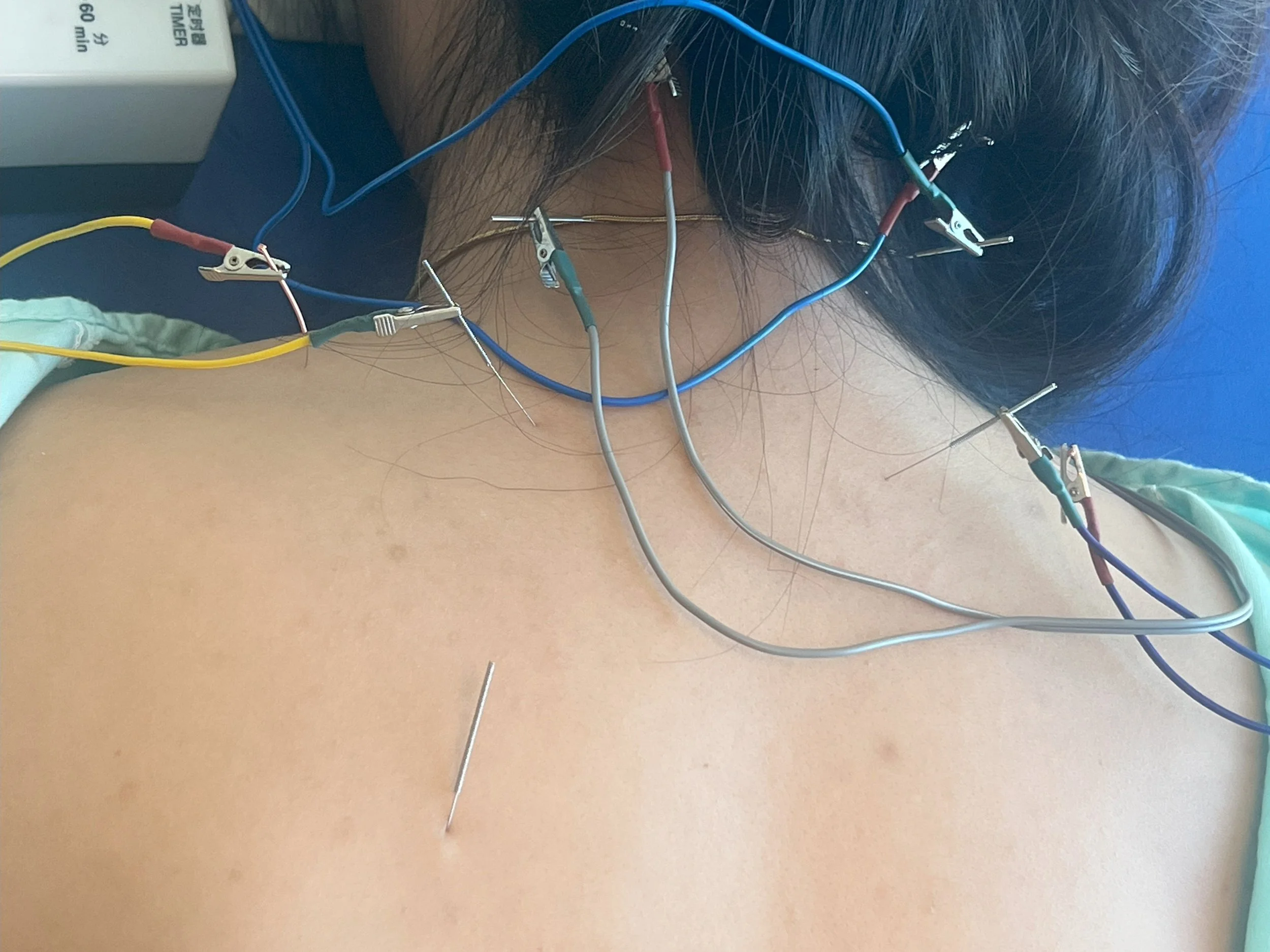 A person undergoing a medical procedure with multiple wires and electrodes attached to their chest, demonstrating an electrocardiogram (ECG) setup.
