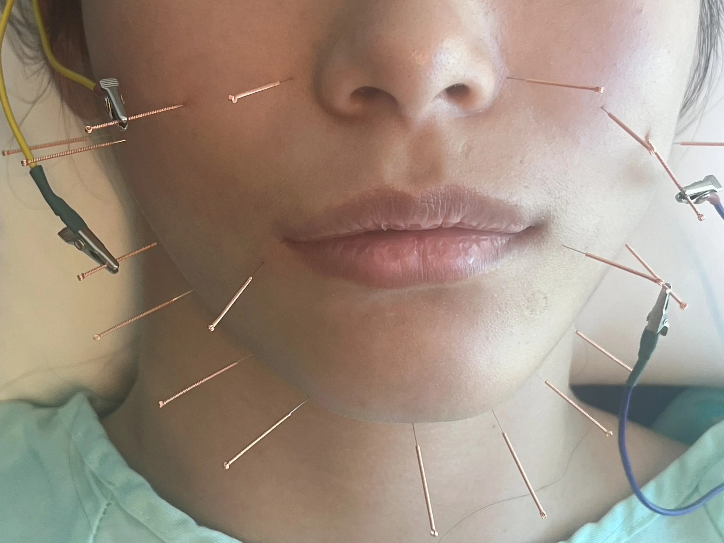 A person undergoing acupuncture treatment with multiple thin needles inserted around their face and neck.
