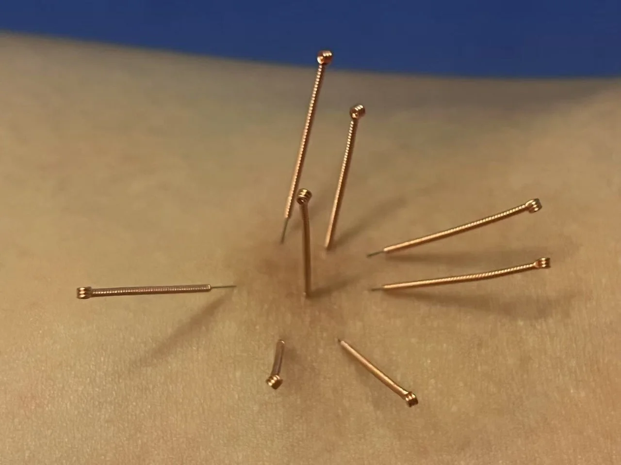 Acupuncture for Scar Healing in Richmond and Greater Vancouver