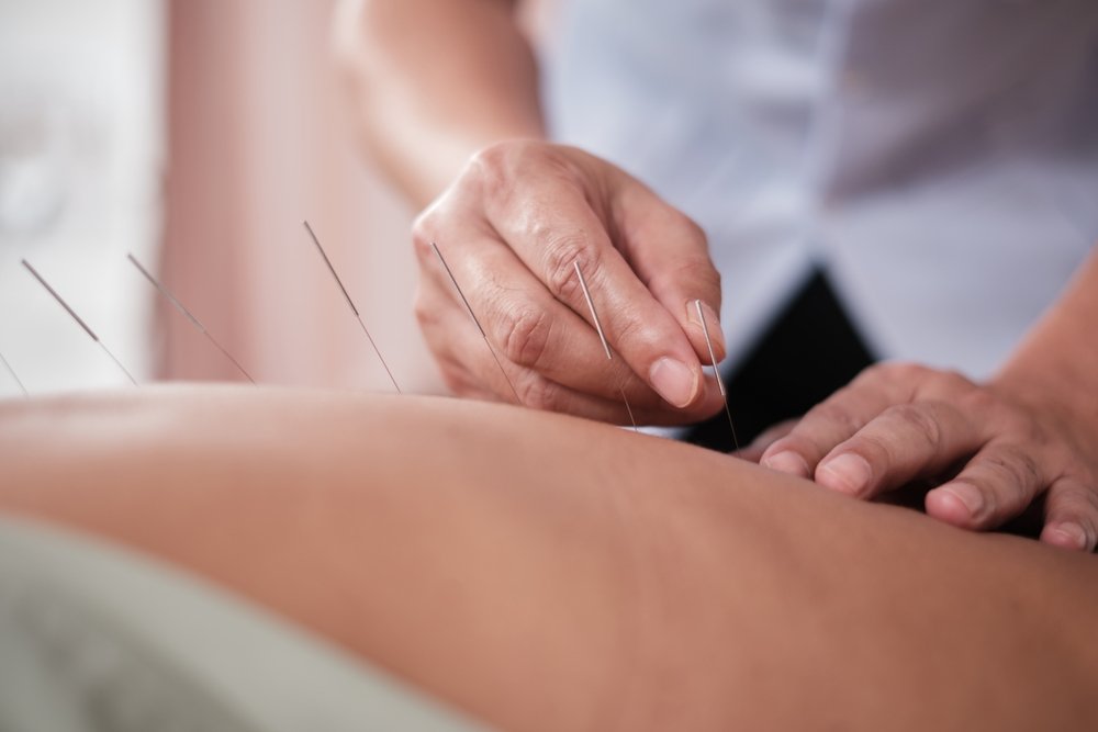 Close-up of acupuncture needles inserted into a patient’s lower back during treatment.