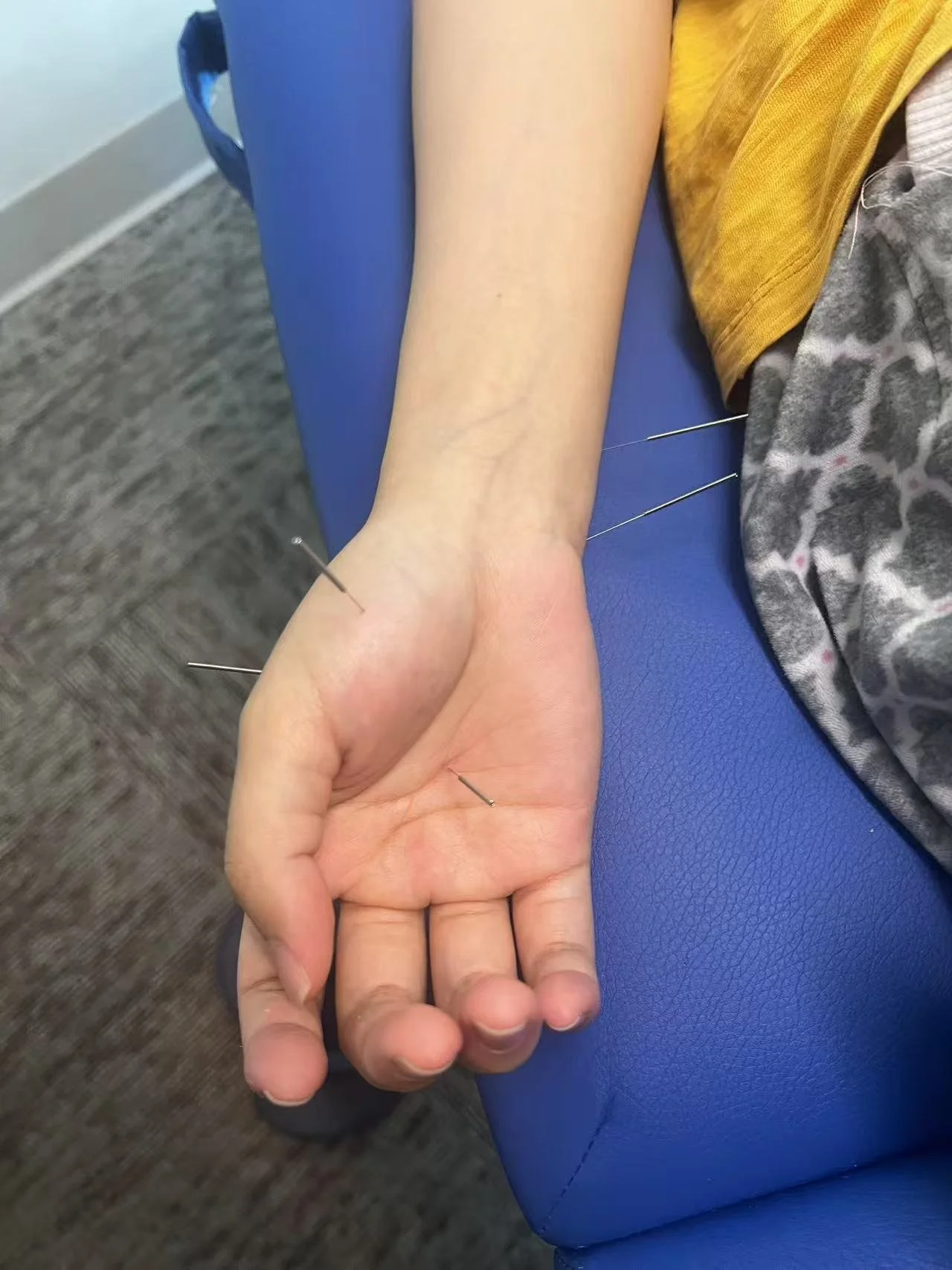 A person's arm is resting on a blue examination table, with several acupuncture needles inserted into their wrist and hand.