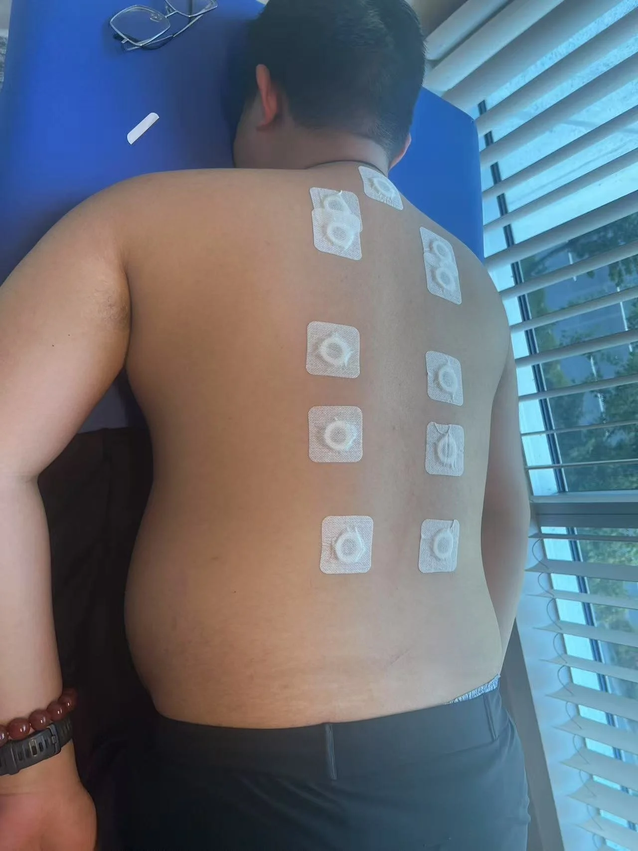 A person lying face down on a table with nine patch electrodes attached to their back for an electrocardiogram (EKG) test. The person is wearing a bracelet on their wrist, and glasses are placed on the table nearby. Sunlight is coming through window