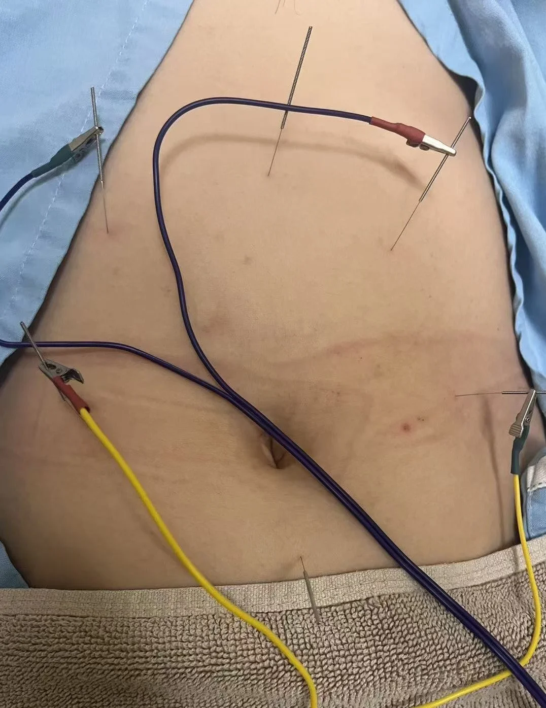 Finding Relief from Stomach Bloating with Acupuncture.jpg
