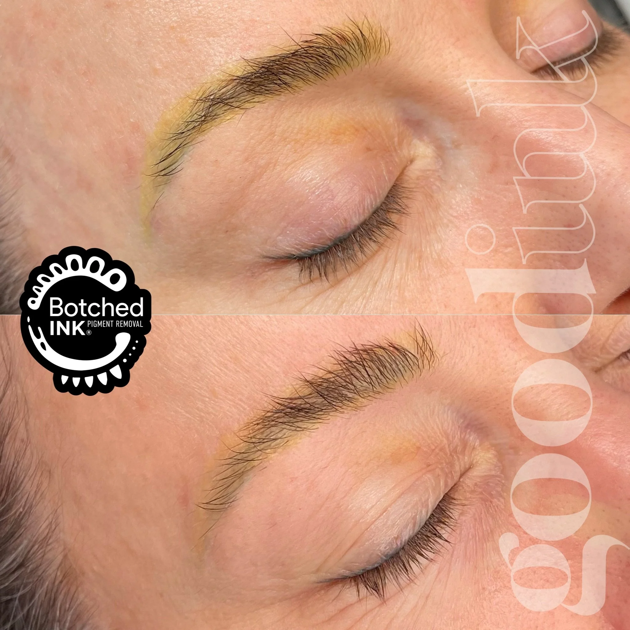 Yellow Brows After Laser