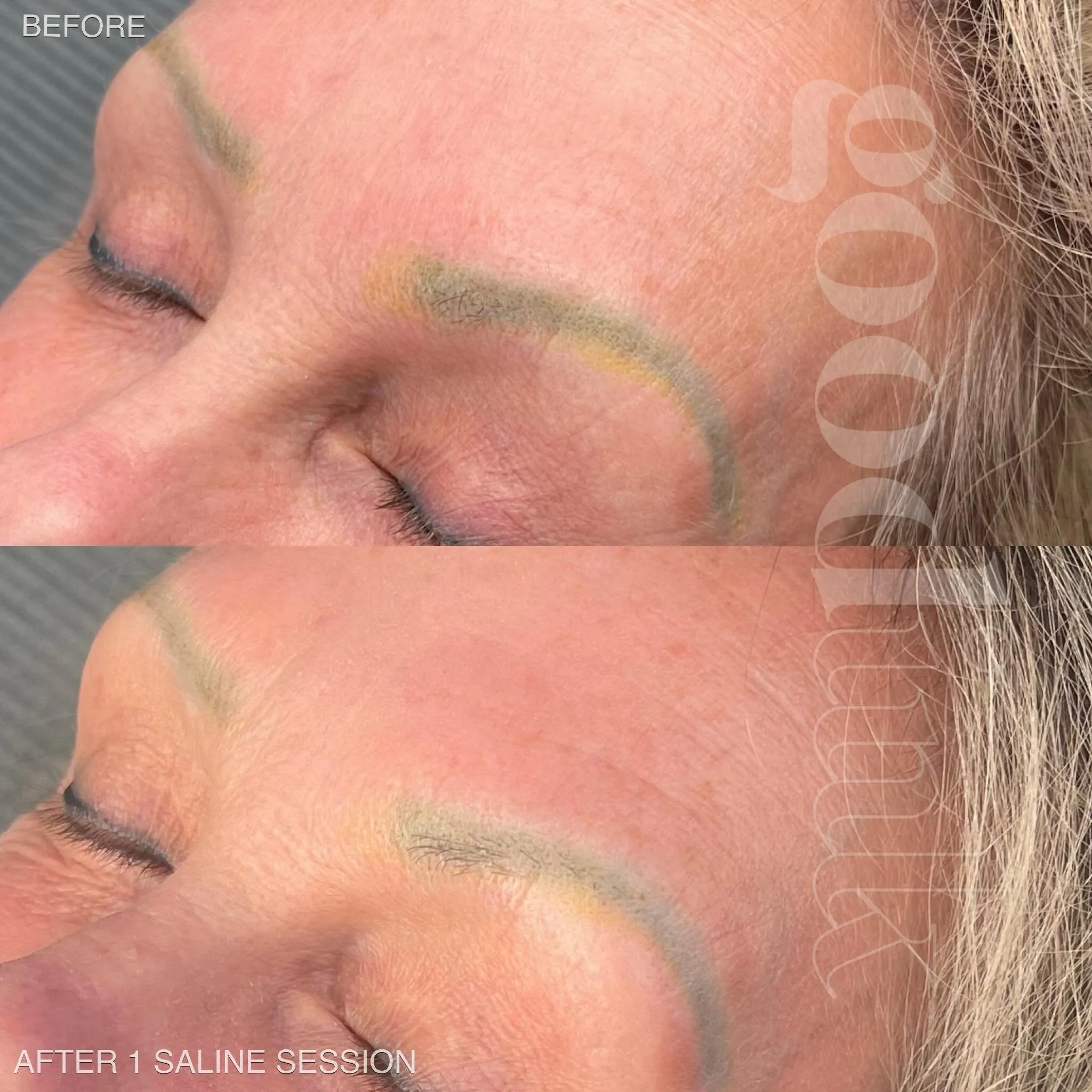 this sweet client has been through ittttttttt

she had previous brow tattooing she wasn&rsquo;t happy with, went through multiple rounds of laser removal, and eventually found her way to me &mdash; before we jump into new brows, we&rsquo;re focusing 