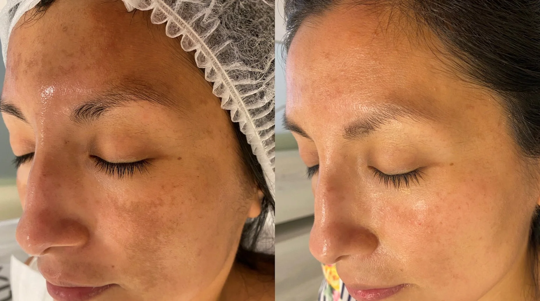 Why Your Melasma Keeps Coming Back (And What Actually Works)