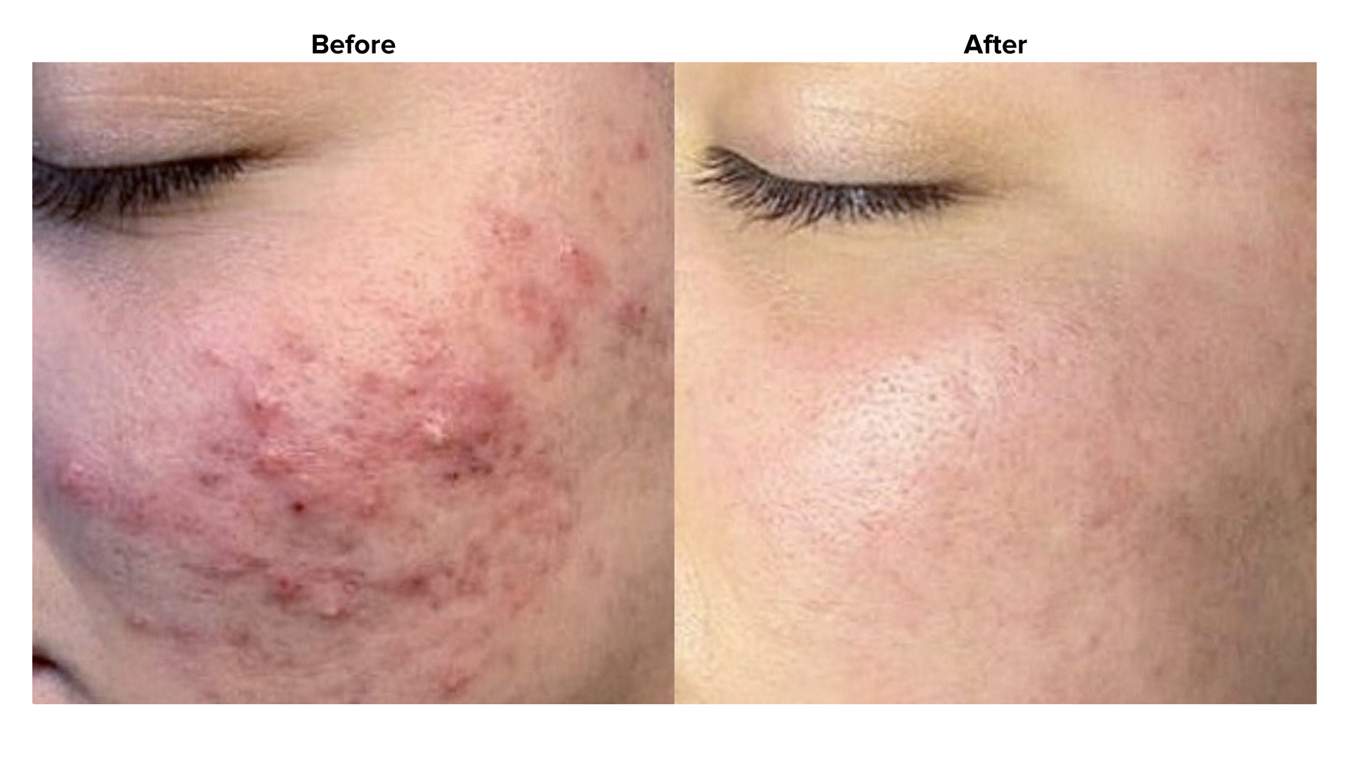 How summer affects acne-prone skin and how to manage it