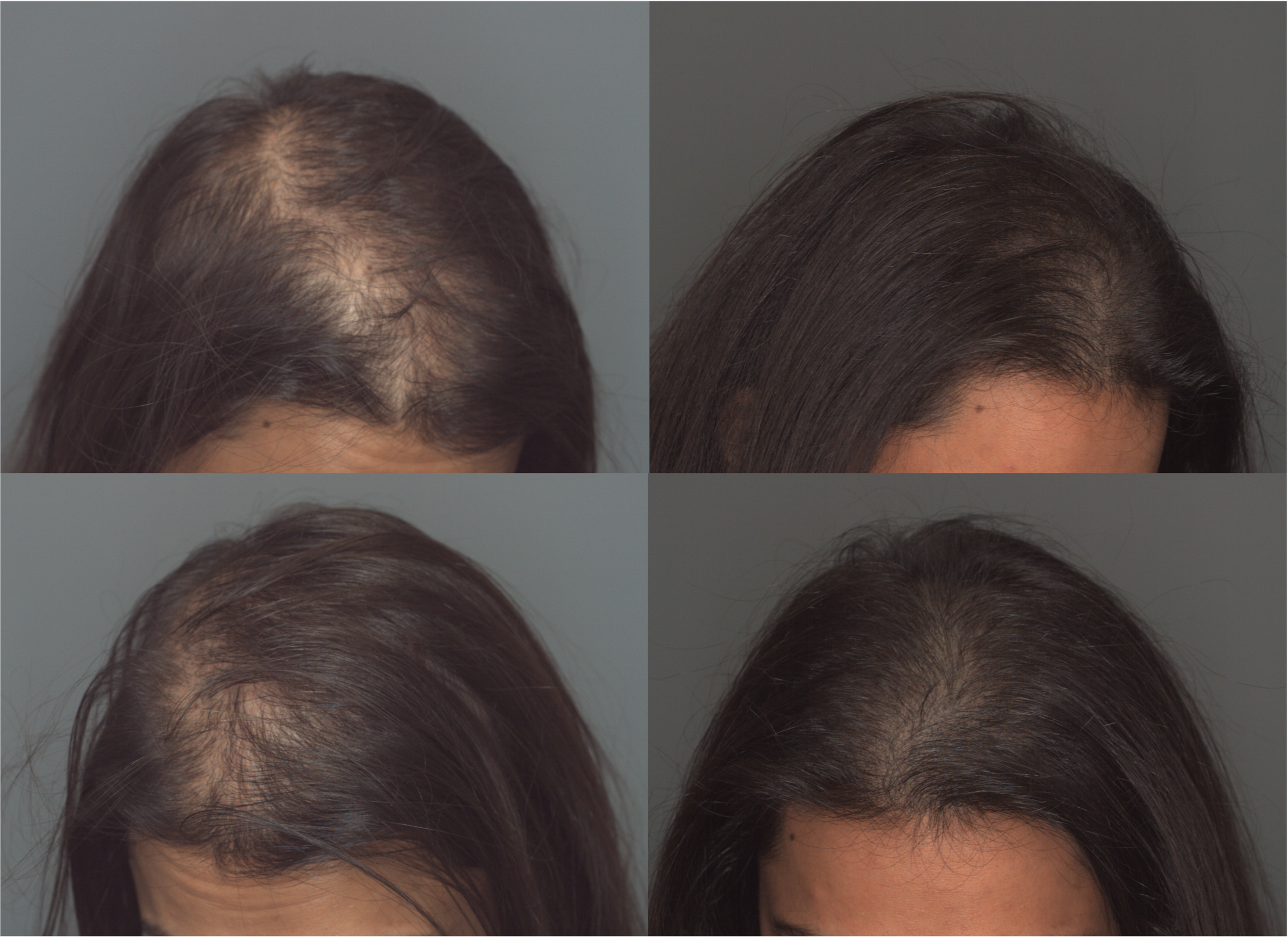 Is Your Hair Loss Hormonal? 5 Signs It's Not What You Think