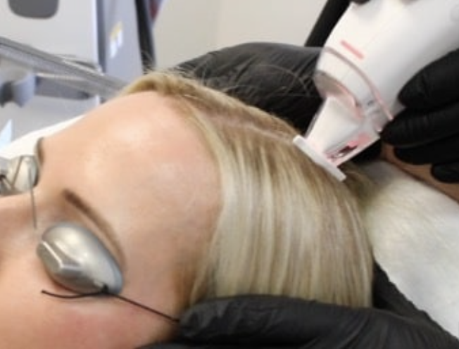 Ultra Hair Restoration at Bare: How Laser Technology Rebuilds Hair Density