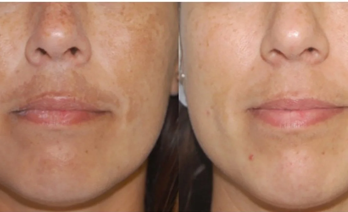 Why Your Holiday Glow Starts Now: The 90-Day Treatment Planning Guide