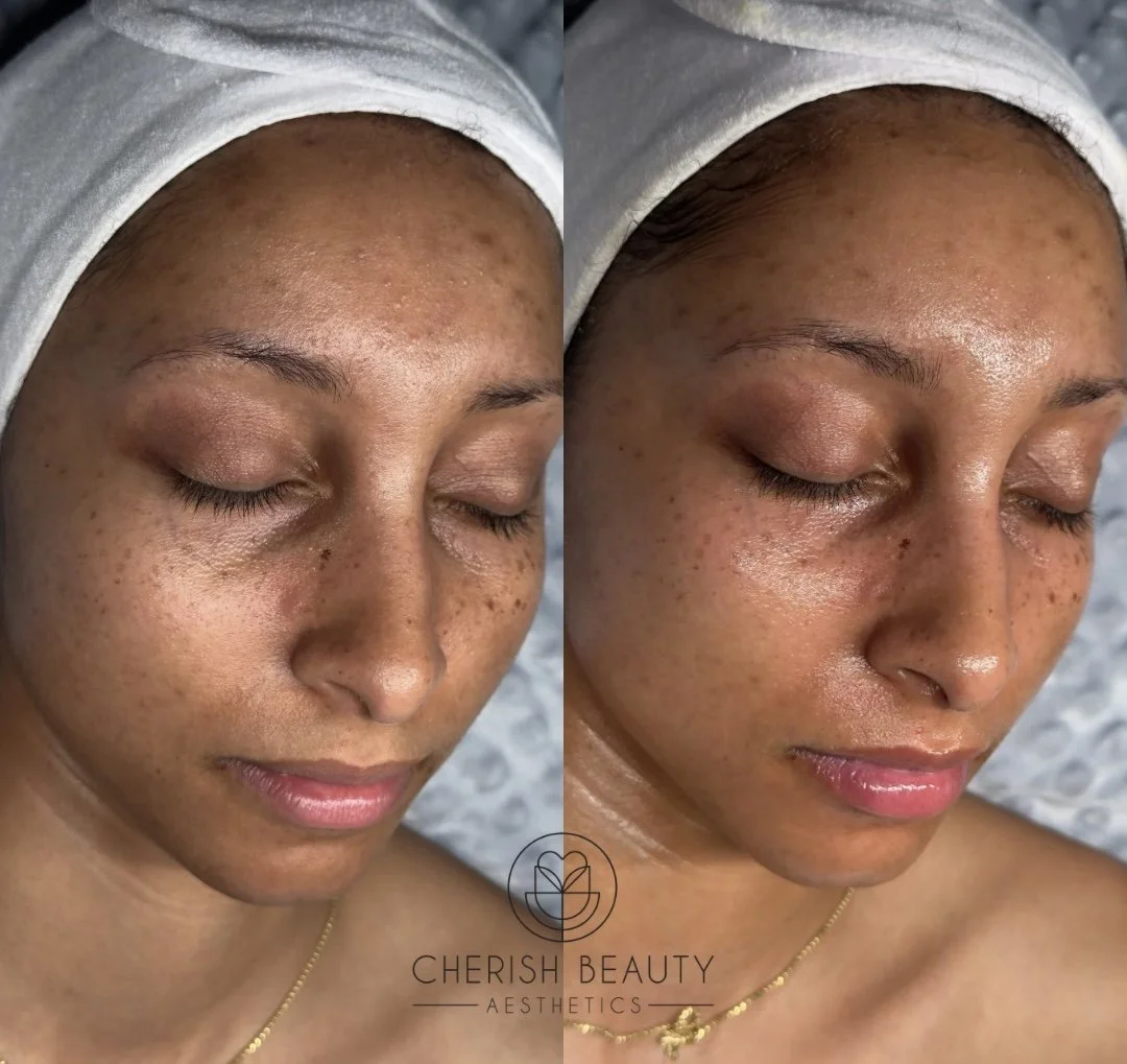 Hyperpigmentation Treatment in Waco, TX