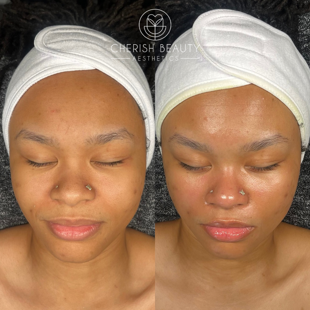 HydroDiamond™ Microdermabration & Hydrodermabration Treatment in Waco
