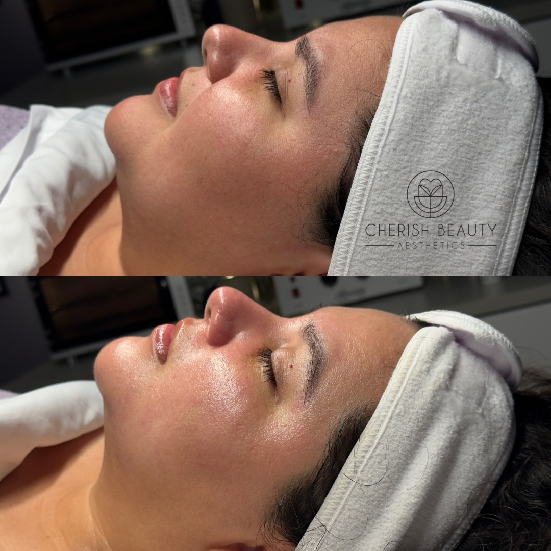 Lira Clinical Exosome Chemical Peel