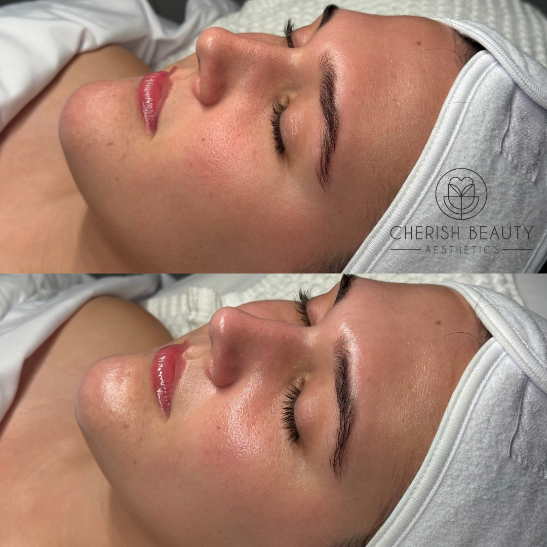 Hydrating Facials in Waco, TX