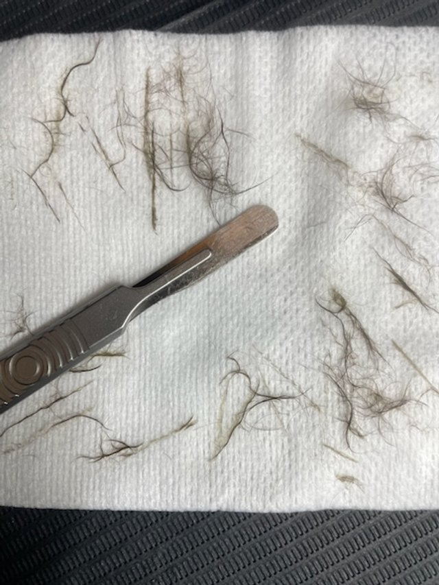 A medical tool, a hair follicle, and scattered hair strands on a white paper towel.
