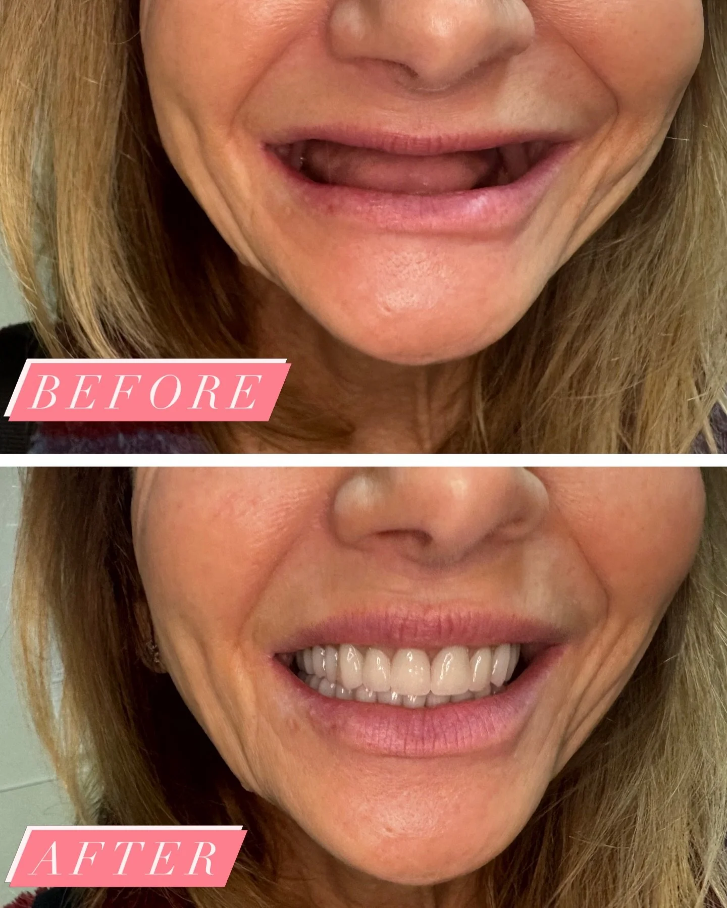 Spring reminds us that renewal is always possible, even for your smile! 🌸🌷

Have years of discomfort and nonfunctional dentures been holding you back? If winter left you feeling stuck, let this season bring your smile back to life.

With custom imp
