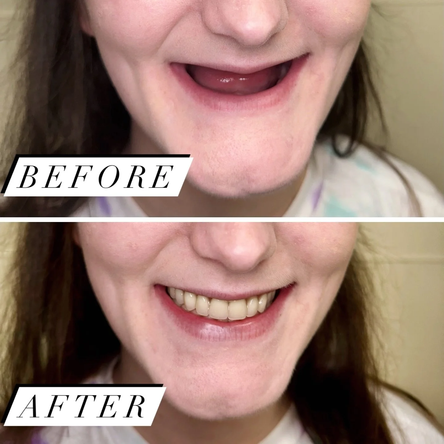 🦷 Let&rsquo;s break the stigma! Dentures are a game-changer for countless smiles, yet they&rsquo;re often seen as a &lsquo;taboo&rsquo; topic. At Gold Standard Dentures, we&rsquo;re here to normalize dentures with open conversations, expert care, an