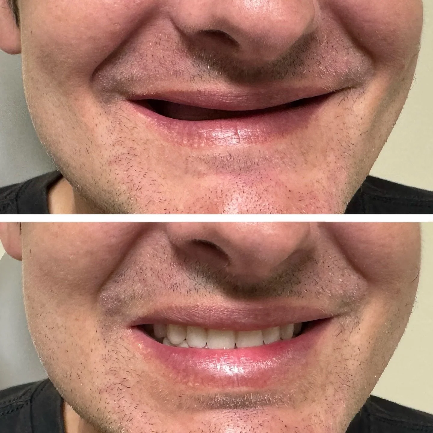 🤔 Did you know dentures are prosthetics, just like artificial limbs? They&rsquo;re not &ldquo;just a denture,&rdquo; they play a vital role in restoring function and confidence. 

Just as a new arm or leg helps someone reclaim mobility, dentures hel