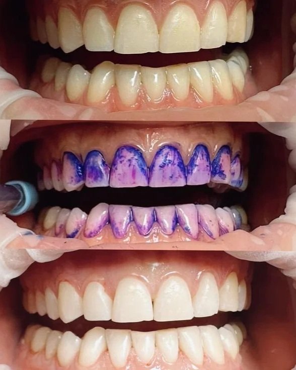 Procedure odontoiatrica con immagini delle gengive e denti prima, durante e dopo il trattamento.