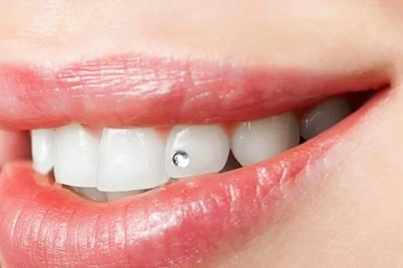 Sorriso con denti bianchi, uno dei quali ha un piercing con una pietra