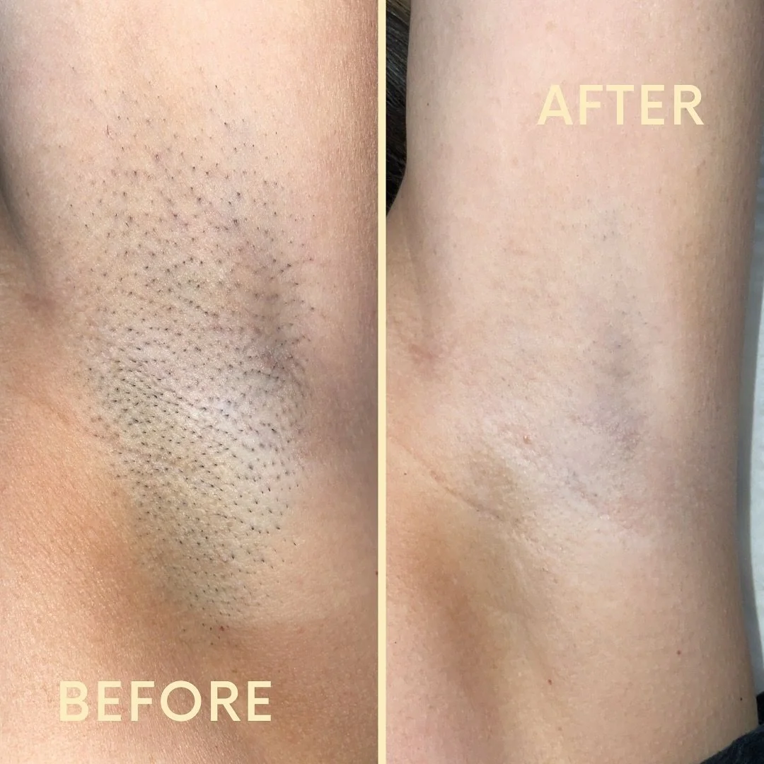 From shadow to shine ✨ Watch your confidence bloom one laser session at a time 🤩 

Our underarm laser hair removal treatment doesn&rsquo;t just smooth the skin, it lifts the weight of insecurity, leaving you free to live with confidence 🙌🏻 

We re