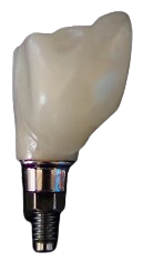 Tooth implants offer a natural-looking and long-lasting alternative to traditional dentures.
